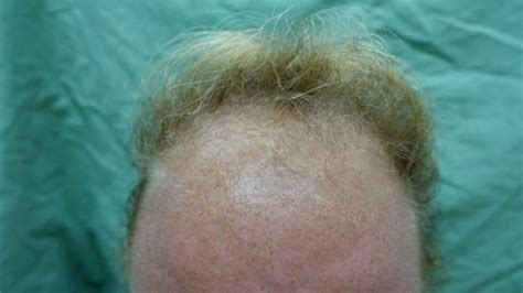 Clitoromegaly Amenorrhea And Hair Loss In A 32 Year Old