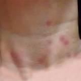 Images of Termite Bite Symptoms