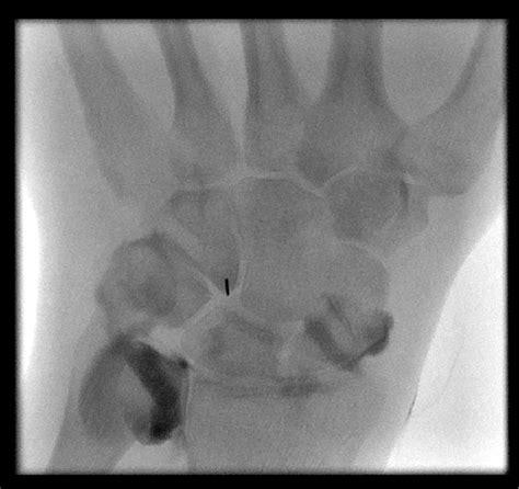 Figure 2 From Wrist Mr Arthrography Technique And Common Pathologies