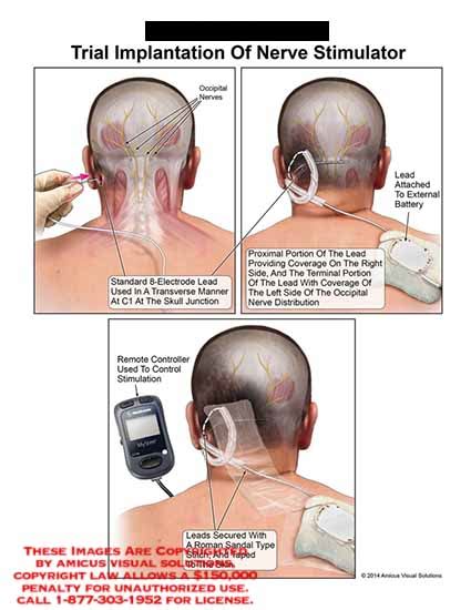 AMICUS Illustration Of Amicus Surgery Implantation Trial Nerve