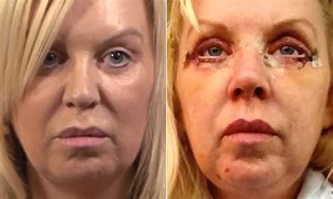 Mother Reveals Trauma After Botched Cosmetic Eye Lift Surger Daily