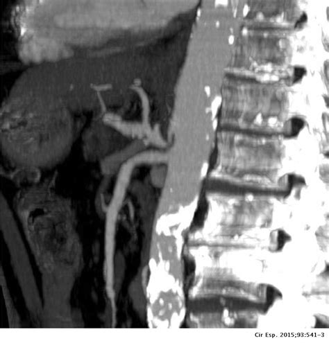 Celiac Artery Stenosis Due To Median Arcuate Ligament Compression A