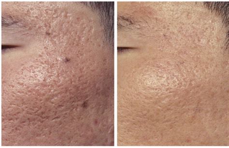 Advanced Acne Scar Treatments With Fractionated Lasers