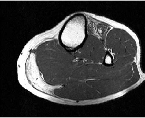 Mri Data Of Calf Muscles A Healthy B And Unhealthy Case C