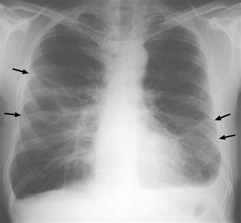 Asbestos When The Dust Settles—an Imaging Review Of Asbestos Related