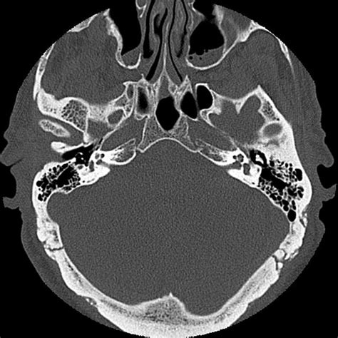 Normal Petrous Temporal Bone Ct Radiology Case