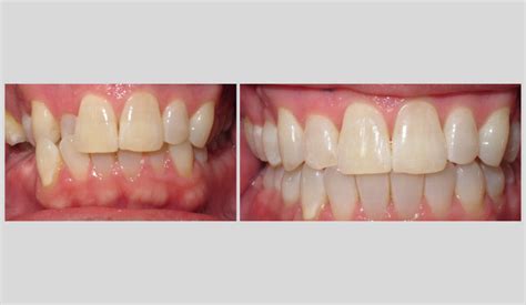 Blog Reagin Orthodontics Summerville Sc