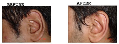 Ear Hair Removal Amrit Clinic