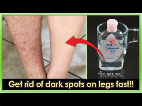 How To Get Rid Of Dark Spots On Legs 10 Home Remedies To Get Rid Of