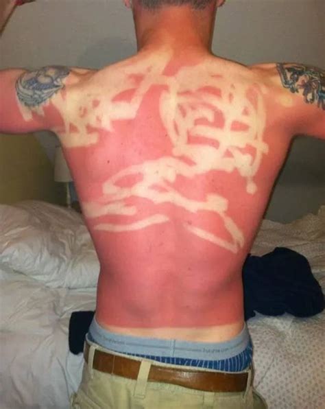 Show Us A Picture Of Your Worst Sunburn Ever