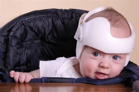 Helmets Not Helpful For Babies With Flat Head Syndrome Study Finds