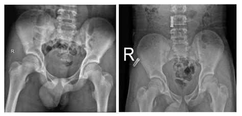 Avulsion Fracture Of The Lesser Trochanter Case Report And Systemic