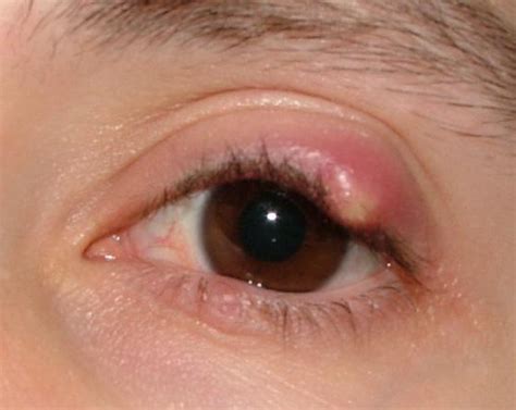 Chalazion Upper Eyelid Meibomian Cyst Century The Symptoms Of Cysts