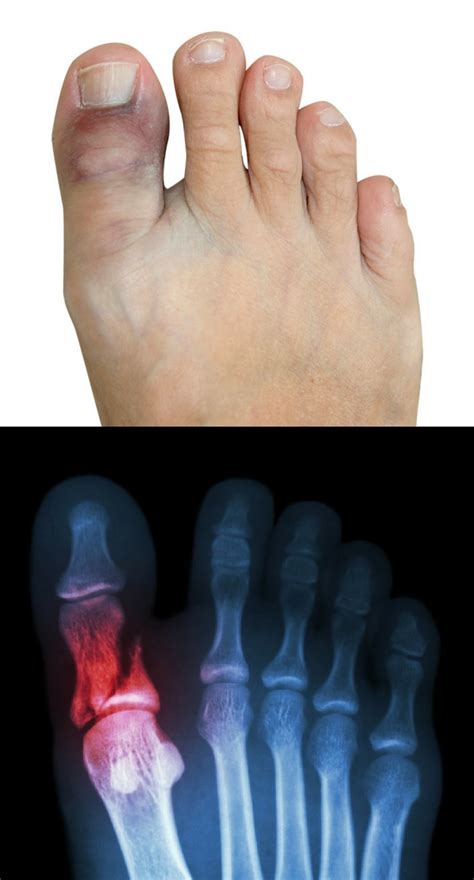 Sprained Big Toe Vs Broken Big Toe Causes Symptoms How To Treat