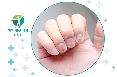 Fingernail Infection Learn In Detail