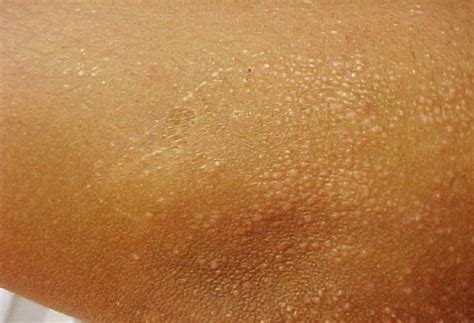 Lichen Nitidus Pictures Treatment Symptoms Causes