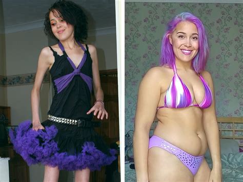 Anorexics Before And After