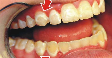 Calcium Spots On Infant Teeth Teeth Bonding