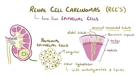Renal Cell Carcinoma Video Anatomy And Definition Osmosis