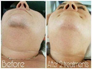 The laser is a concentrated beam of light that uses heat to destroy the follicle and helps delay future hair growth. specifically, the laser targets melanin (pigment) in the skin or hair, so if skin color and laser. Testimonials: Laser Treatment and Microneedling reviews Yuma