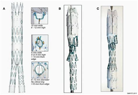 Branched And Fenestrated Endovascular Stent Graft Techniques