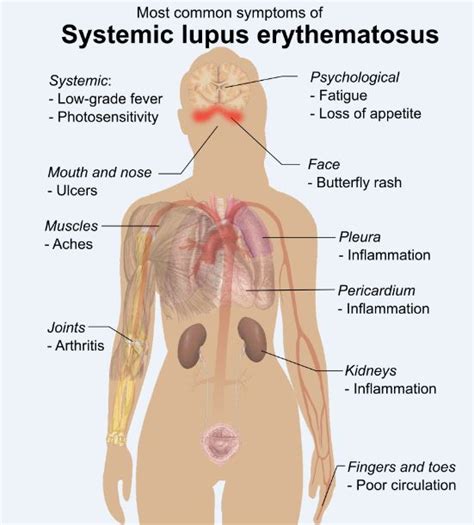 Lupus Latest Facts Causes Symptoms And Treatments Gilmore Health News