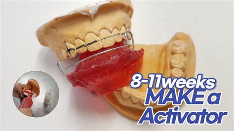Orthodontic교정 Make A Activator 액티베이터 Youtube