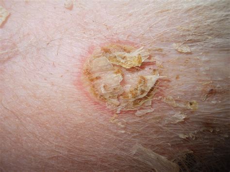 Image Gallery Secondary Skin Lesions Clinicians Brief