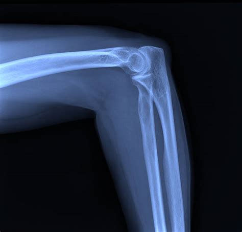 Best Elbow Xray Stock Photos Pictures And Royalty Free Images Istock