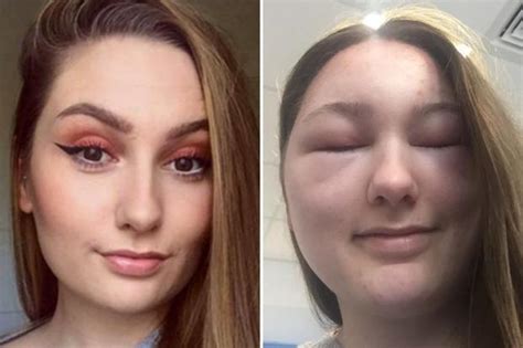 Teenagers Face Felt Like It Was On Fire When She Suffered Allergic Reaction To Hair Dye That