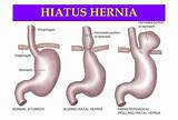 Hiatal Hernia Diagnosis And Treatment