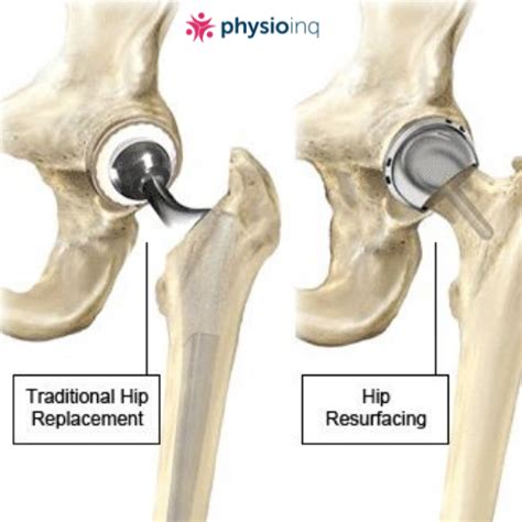 What Is A Hip Resurfacing Procedure