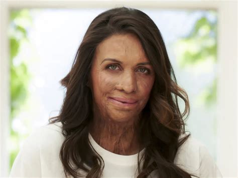 Turia Pitt Delivering Keynote At OT Conference Freedom Live