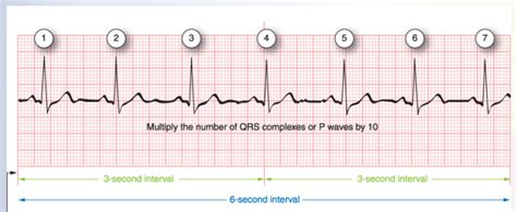 Traumagency Count Irregular Rhythm Heart Rate
