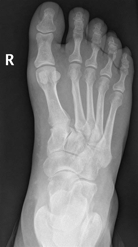 Exams today will determine how long he's out. Lisfranc injury | Image | Radiopaedia.org