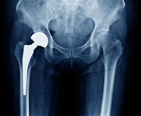 X Ray Scan Image Of Hip Joints With Orthopedic Hip Joint Replacement Or
