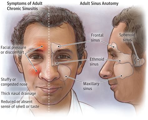 Adult Chronic Sinusitis Allergy And Clinical Immunology Jama The