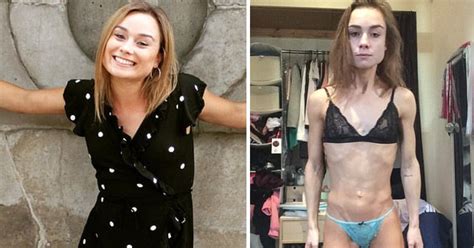 Anorexic Ballet Dancer Said Her Eating Disorder Made Her Dance 10 Hours
