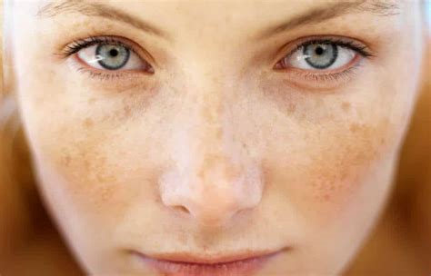 Sculpt Difference Between Freckles And Sunspots Sculptdtlacom