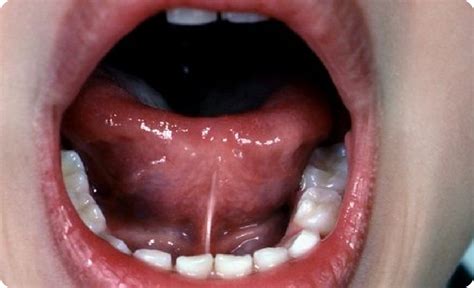 Tongue Tie Weybridge Myokids Dental
