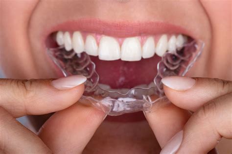 Wash the invisalign retainer with soap and water asap. Clear Aligner Costs - Aligners UK