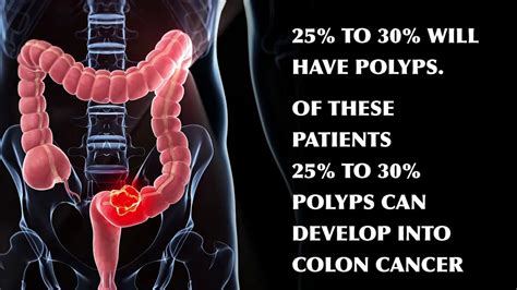 What Are Polyps In The Colon And Can They Develop Into Cancer Youtube