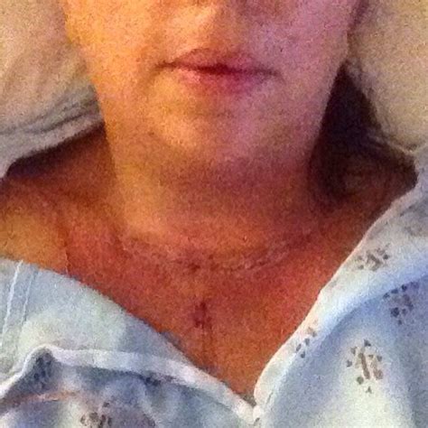 Pin On Post Thyroidectomy Journey Of Healing