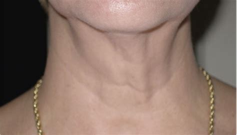 Skintyte Before And After Sciton Aesthetic And Medical Lasers Aesthetic