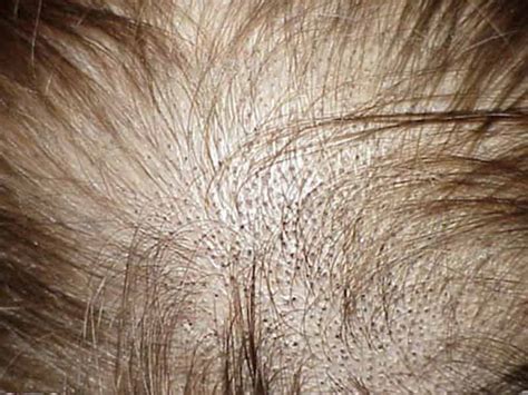 What Are The Signs Of New Hair Growth Lewigs