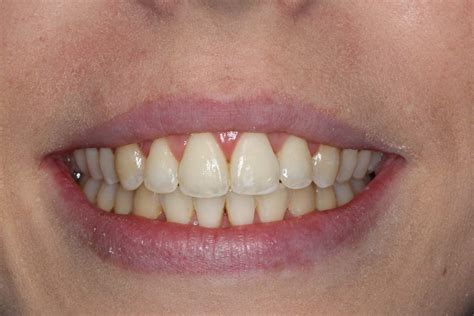 How To Correct Protruding Front Teeth In Adults Balsall Common Dental