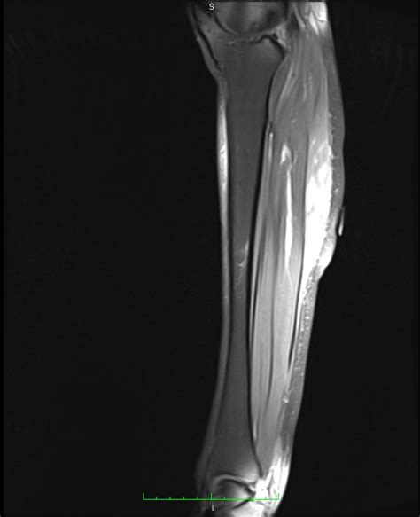A magnetic resonance imaging (mri) was performed on a normal subject; Vasculitis Presenting as Calf Pain With Muscle-Limited ...