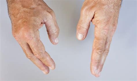 Early Signs Of Arthritis In Fingers Livestrongcom