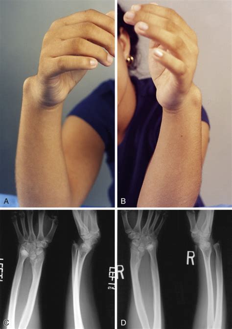 Malformations And Deformities Of The Wrist And Forearm