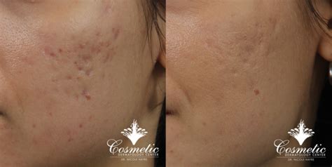 Ipl Or Microneedling Which Is Best For Acne Scars Cosmetic